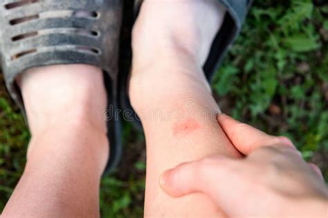 Leg With Red Spot Caused By Insect Bite On Leg Skin Stock Image