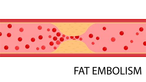 Fes Fat Embolism Syndrome Early Identification Is Critical