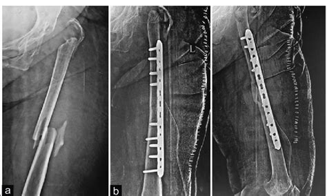 (a) Radiograph showing fracture shaft femur with butterfly fragment and ...