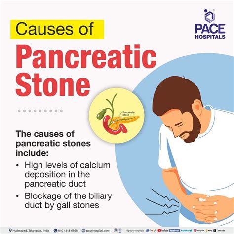 Pancreatic Stones Causes Symptoms Complications And Prevention