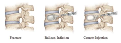 Vertebral Compression Fracture Severity Assessing The Impact