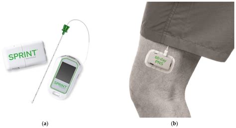 The SPRINT PNS System Utilized By Langford And Mauck To Treat Meralgia