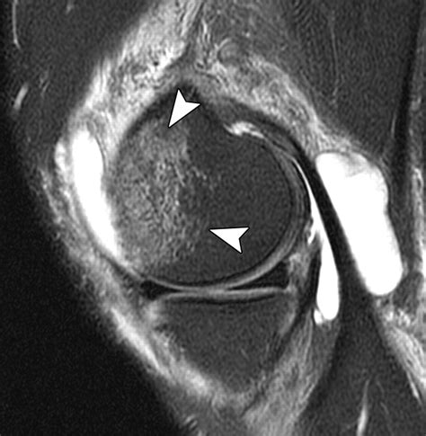 The Posterolateral Corner Of The Knee AJR