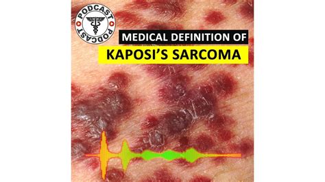 Kaposis Sarcoma What Is Kaposis Sarcoma Medical Definition Of