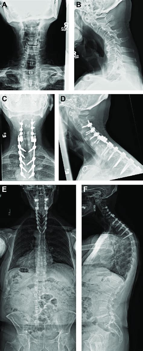 Preoperative Anteroposterior A And Lateral B Radiographs And Final