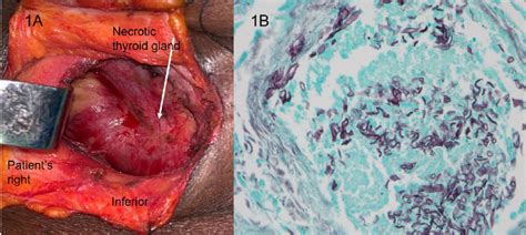 A Intraoperative Photo Showing The Necrotic Thyroid Gland Arrow