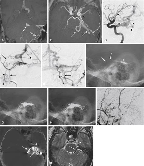 Endovascular Management Of Dural Arteriovenous Fistulas Clinical Tree