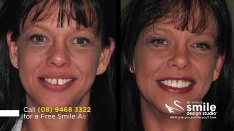 Fixing Crooked Teeth With Porcelain Veneers Smile Design Studio Youtube