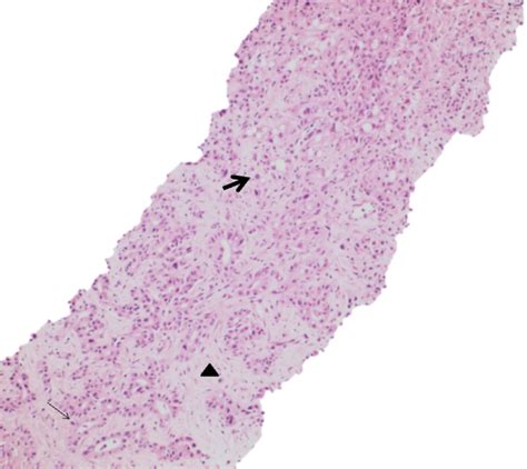 Pathology Pearls Intrahepatic Cholangiocarcinoma Aasld