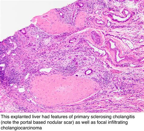 Pathology Outlines Primary Sclerosing Cholangitis