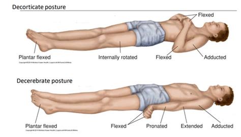 Neuro Chp Intracranial Pressure Flashcards Quizlet