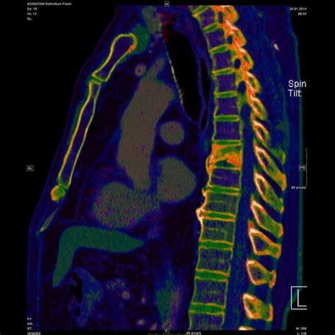 Somatom Definition Flash Ct Scanner Siemens Healthineers Vietnam