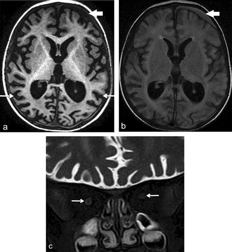 Brain Mri At Age Years A Axial Volumetric T Weighted Image Shows