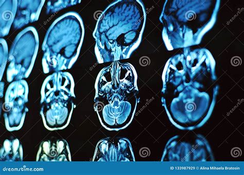 Het Aftasten Van Het Magnetische Resonantiebeeld Van De Hersenen Mri