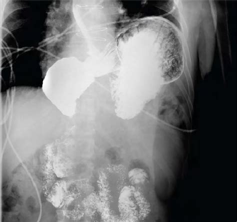 Upper Gastrointestinal Contrast Study Performed With Use Of Fluoroscopy