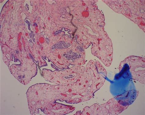 Pathology Outlines Yolk Sac Tumor