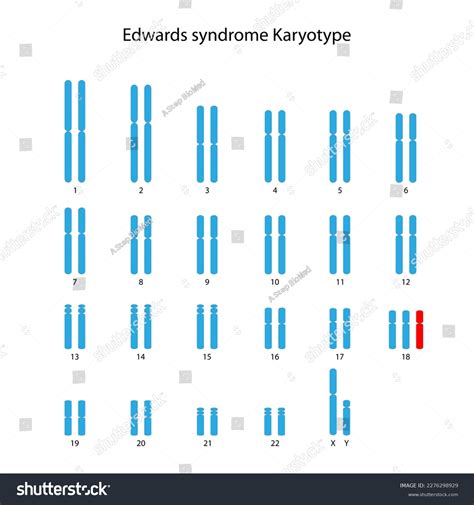 Edwards Syndrome Punnett Square