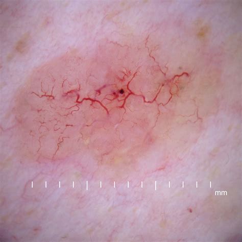 File Dermoscopy Nodular Basal Cell Carcinoma  Wikipedia