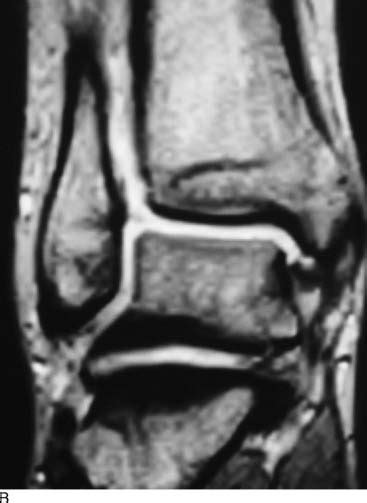 ankle sprains ankle instability  syndesmosis injuries