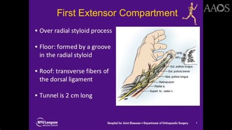 First Extensor Compartment Release For De Quervains Tenosynovitis