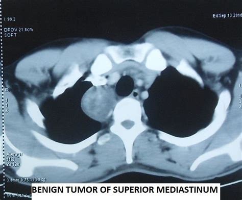 Cect Thorax Showing Right Endobronchial Endotracheal Mass With