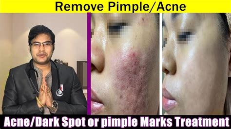 Remove Pimple Marks Acne Marks Dark Spots Black Spots Fast How