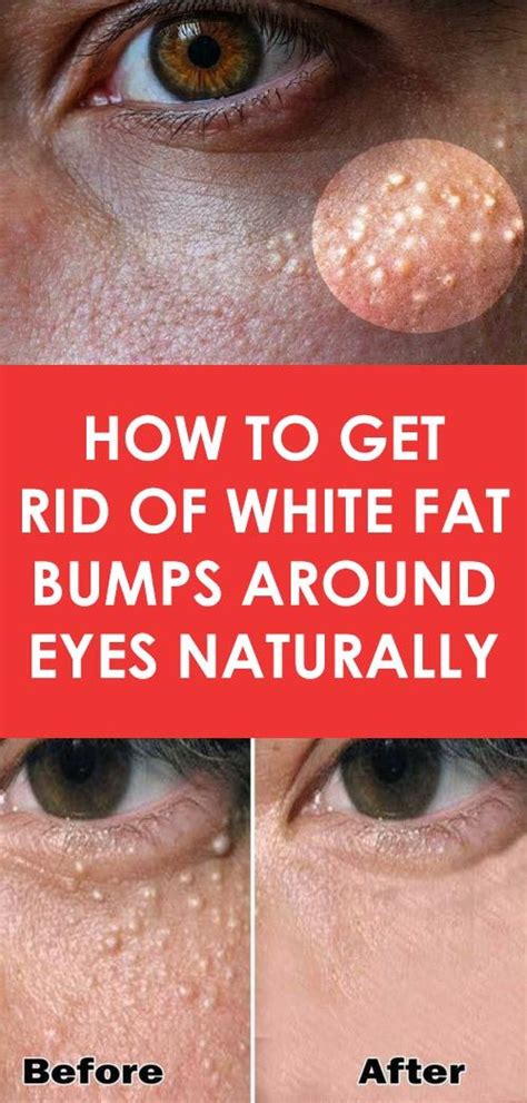 How To Get Rid Of White Fat Bumps Around Eyes Naturally V Remedies