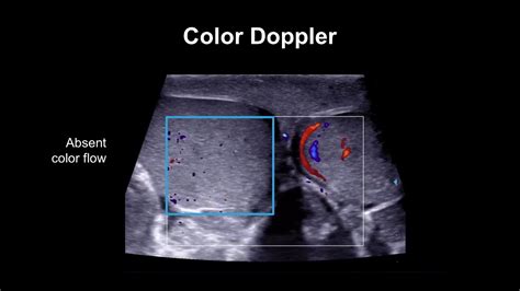 Torsion Detorsion Testis Radiology