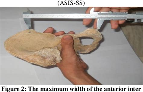 Figure From Sexual Dimorphism Observed In Anterior Border Of Human