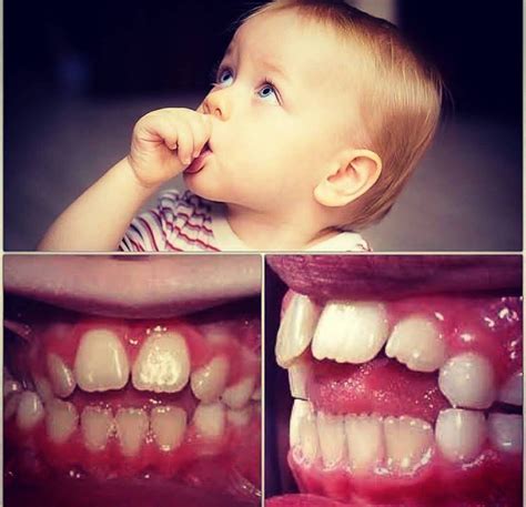 Pin by Hafeez Rahman on tooth | Dental, Pediatrics, Teeth