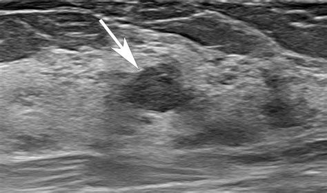 A 28-year-old woman with a mass in the right breast. A. Breast US shows... | Download Scientific ...