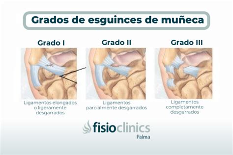 Muñeca abierta o esguince de muñeca Tratamiento en FisioClinics