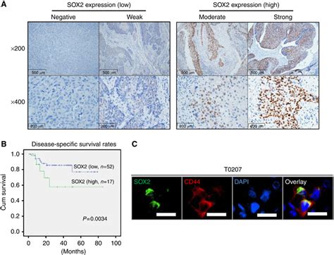 Sox2 Expression In Primary Hnscc Specimens A Immunohistochemical