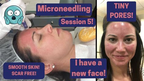 Microneedling Procedure For Acne Scars Textured Skin Vlog Youtube