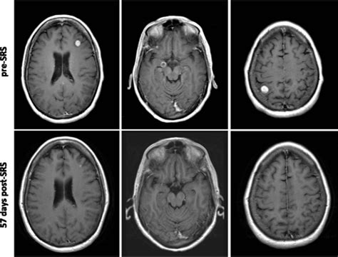 Melanoma Brain Metastases Treated With Stereotactic Radiosurgery And