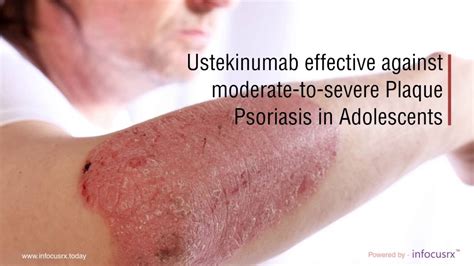 Ustekinumab Effective Against Moderate To Severe Plaque Psoriasis In