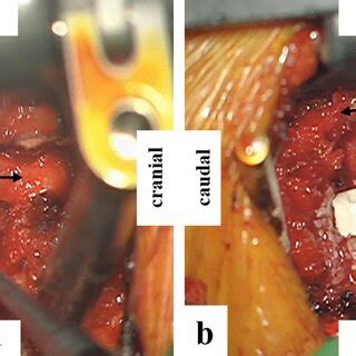 Intraoperative Images A Vertebral Artery Double Arrow Mobilization