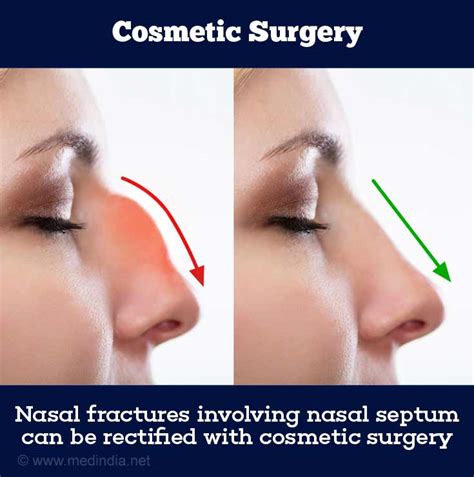 Broken Nose Nasal Fracture Age Groups And Types Symptoms