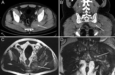 Piriformis Syndrome Mri