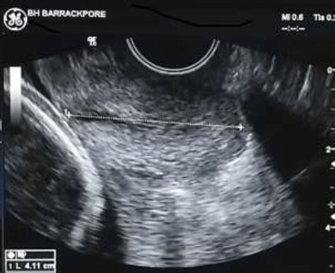 Trans Vaginal Sonographic Image Of The Cervix Download Scientific