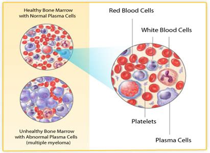 Multiple Myeloma Diagnosis | Modern Cancer Hospital Guangzhou, China