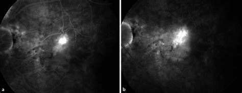 Early A And Late B Phase Of Fundus Fluorescein Angiography At Download Scientific Diagram