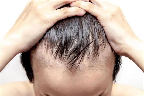 Understanding And Treating Male Pattern Baldness Prp Injection Revive