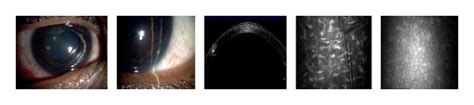 Slit Lamp Photographs Of Corneal Foreign Bodies And Corresponding