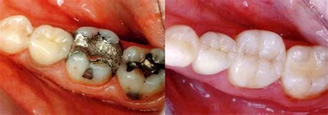 Before After Morgan Creek Dental Clinic South Surrey BC