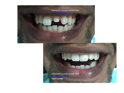 Broken Anterior Teeth Restored With Emax Zirconia Crown