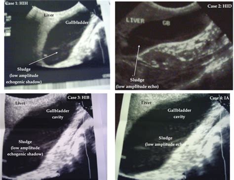 Gallbladder Ultrasound Sludge