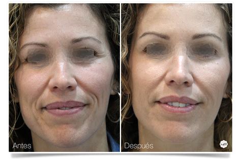 Tratamiento Facial completo Medicina Estética Facial Clínica Áureo