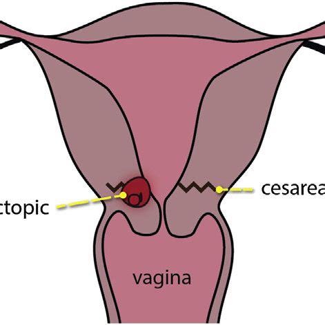 Schematic diagram of a cesarean section scar ectopic pregnancy ...