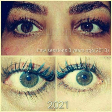 Colored Contact Lenses Laser Eye Color Change Turkey Without Surgery